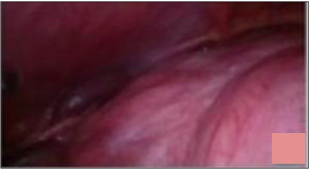 large uterine mass in abdominal cavity